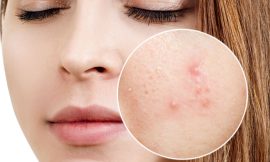 Manchas de Espinhas como remover com tratamentos?