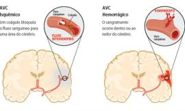 Dicas para evitar o AVC