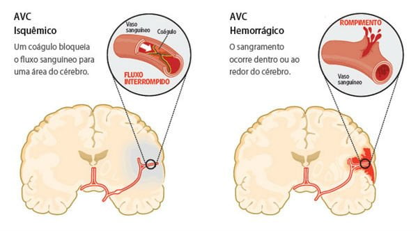 evitar o avc