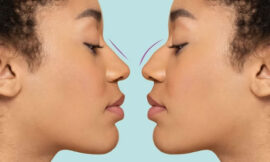 Os Mitos e Verdades sobre a Rinoplastia