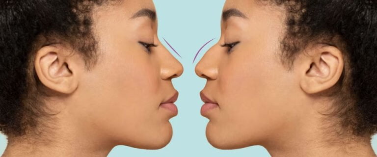 Leia mais sobre o artigo Os Mitos e Verdades sobre a Rinoplastia