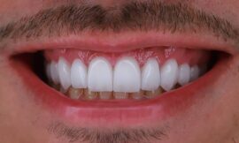 Lentes de Porcelana: A Solução Estética para um Sorriso Perfeito